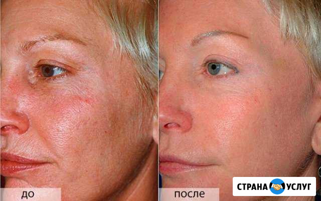 Омоложение по авторской программе Нижний Тагил - изображение 1