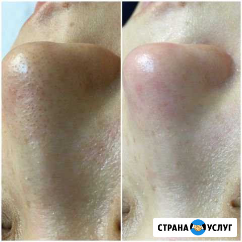 Ультразвуковая чистка лица Курск - изображение 1