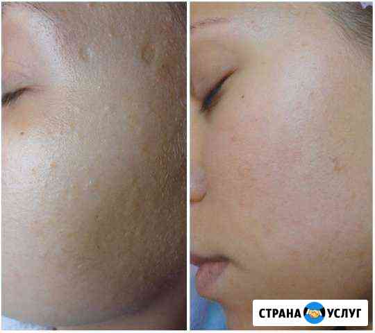Услуги косметолога.Ультрозвуковая чистка Севастополь
