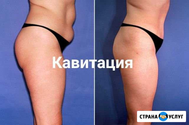 Аппаратная коррекция фигуры Воткинск - изображение 1