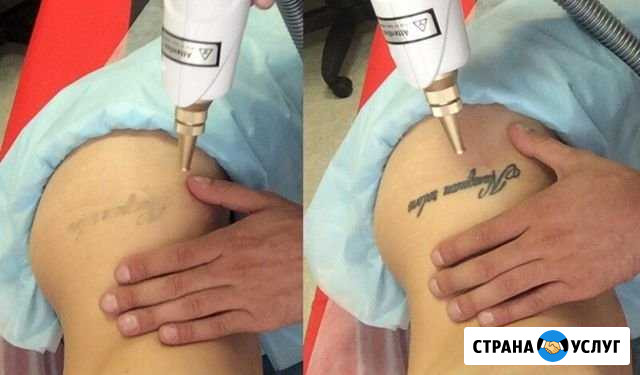 Удаление тату,татуажа неодимовым лазером Самара - изображение 1