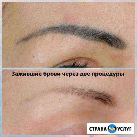 Лазерное удаление татуажа любой зоны и татуировок Самара