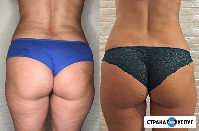 Кавитация и вакуумный массаж Балашиха - изображение 1