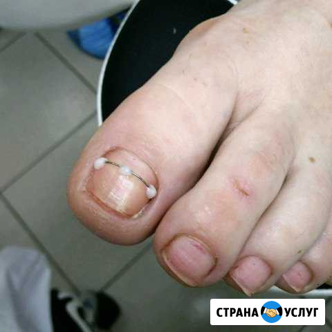 Коррекция вросших деформированных ногтей Горячий Ключ - изображение 1