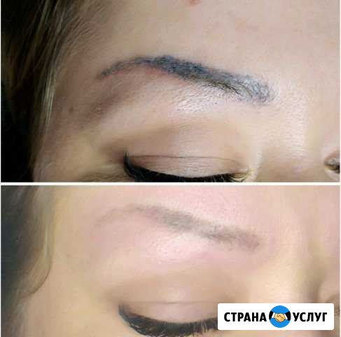 Удаление татуажа, татуировок неодимовым лазером Улан-Удэ - изображение 1