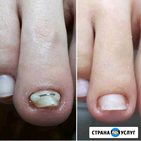 Кабинет педикюра. Работа с вросшими и проблемными Майкоп - изображение 1