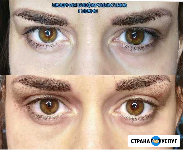 Лазерная Блефаропластика Петропавловск-Камчатский - изображение 1