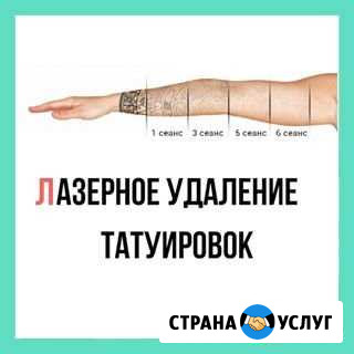 Удаление тату и татуажа Ялта - изображение 1