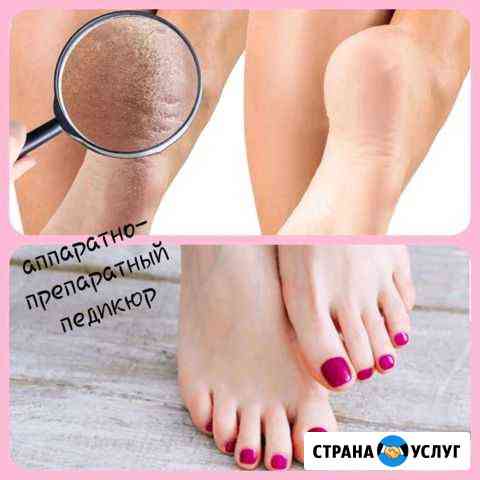 Аппаратно-препаратный педикюр Псков