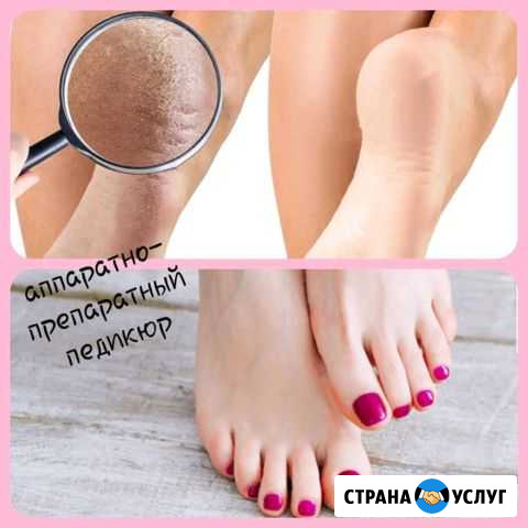 Аппаратно-препаратный педикюр Псков - изображение 1