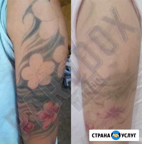 Лазерное удаление татуировок и татуажа Томск - изображение 1