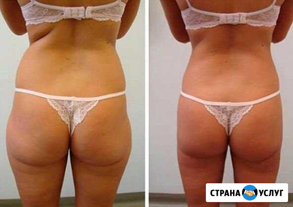 Коррекция фигуры Волгоград - изображение 1