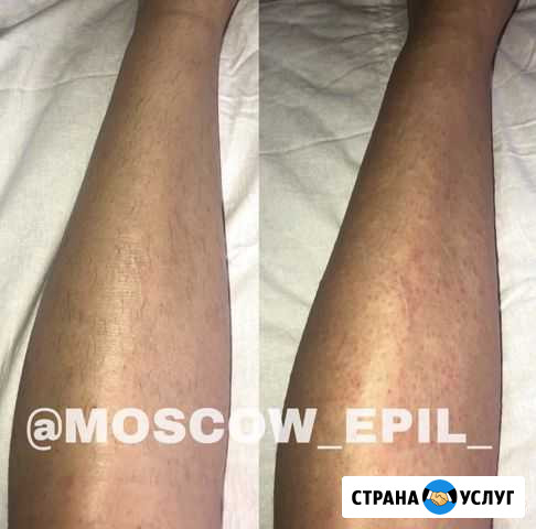 Электроэпиляция Одинцово - изображение 1