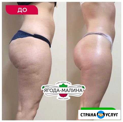 Антицеллюлитный массаж Омск - изображение 1