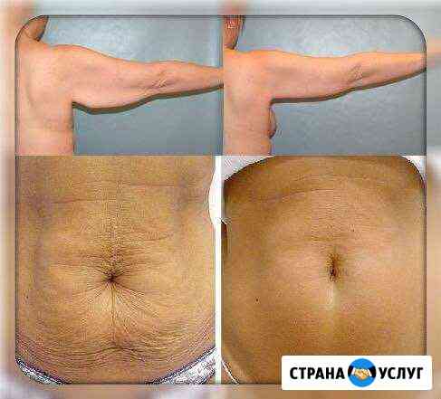 Кавитация,лимфодренаж Кострома