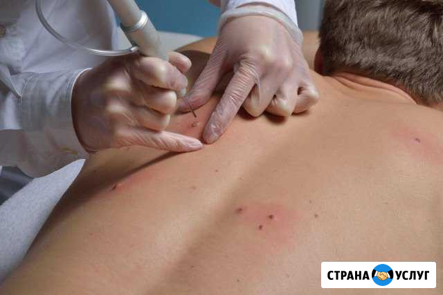 Удаление папиллом, бородавок, шипиц Железногорск - изображение 1