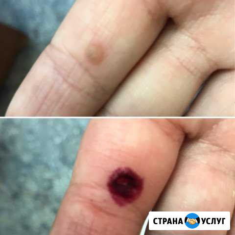 Удаление новообразований Канск - изображение 1