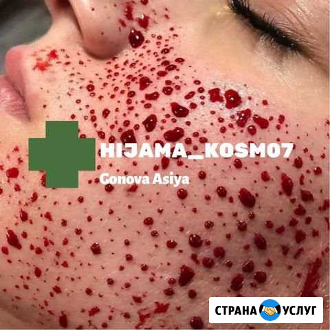 Обучение хиджаме и Капиляротерапии Нальчик - изображение 1