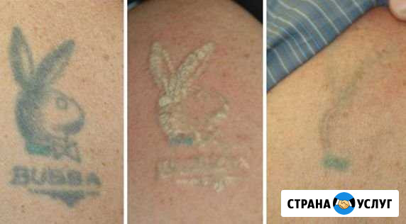 Удаление татуировок и татуажа Волгоград - изображение 1