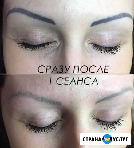 Лазерное удаление татуажа и тату Уфа - изображение 1