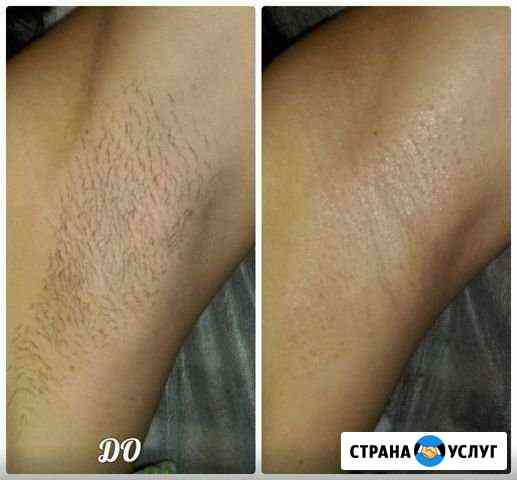 Депиляция Балаково