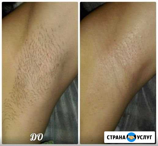 Депиляция Балаково - изображение 1