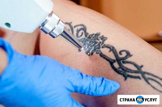 Удаление татуировок лазером Чебоксары - изображение 1