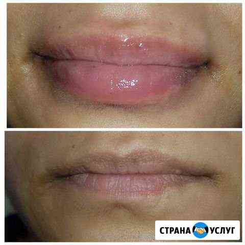 Увеличение объема губ в Ханты-Мансийске Ханты-Мансийск