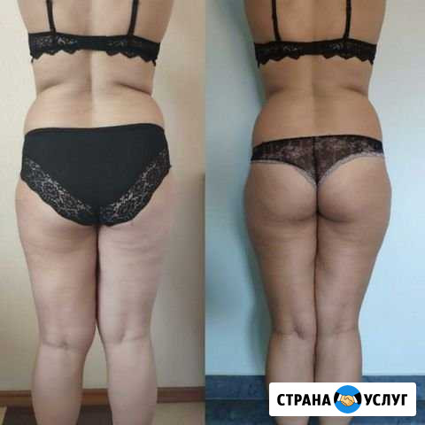 Антицеллюлитный массаж, коррекция фигуры Краснодар - изображение 1