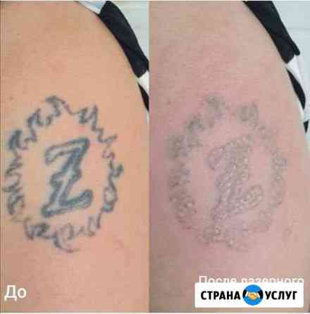 Удаление татуажа, татуировки Самара