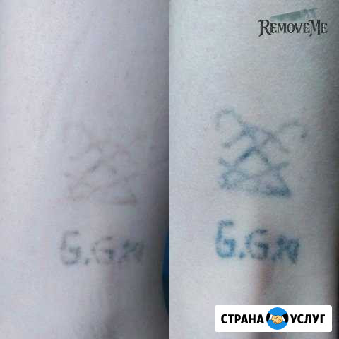 Удаление татуировок и перманентного макияжа Воронеж - изображение 1