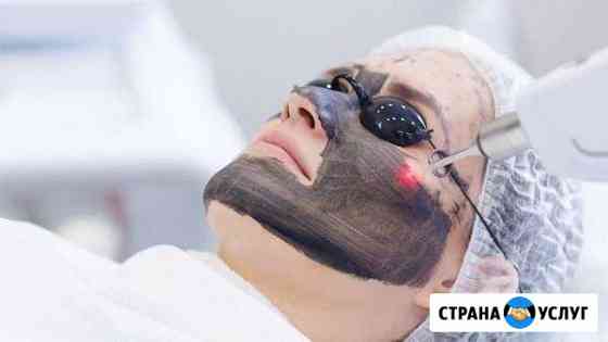 Карбоновый пилинг Кемерово