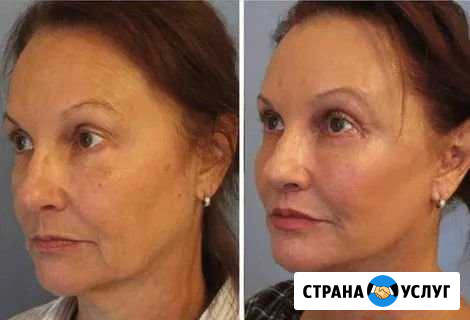 Лифтинг для лица, коррекция фигуры Загорянский - изображение 1