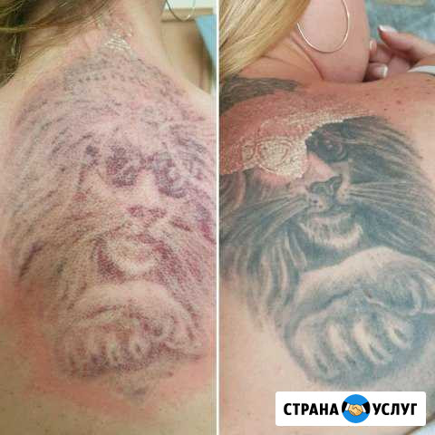 Удаление тату Ростов-на-Дону - изображение 1