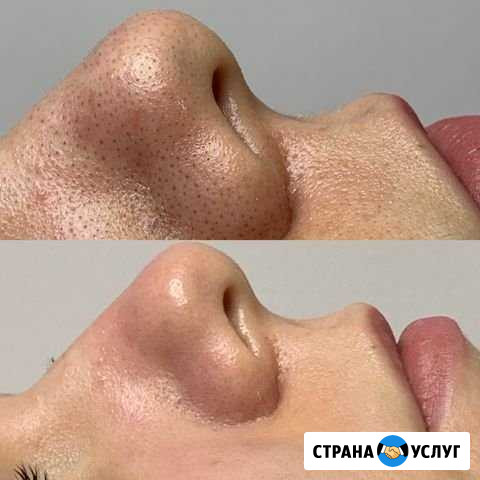 Чистка лица Тюмень - изображение 1
