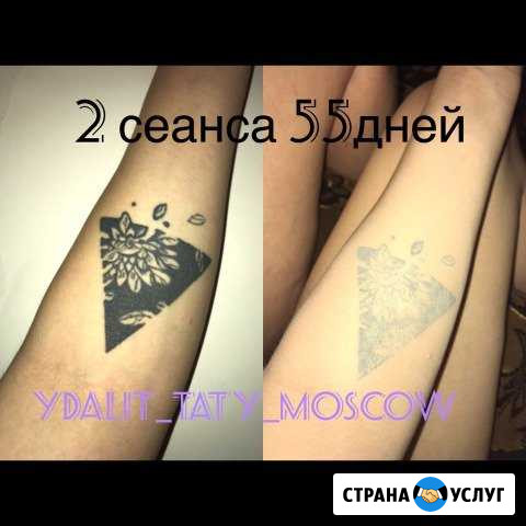 Удаление тату,Татуаж,пилинг,тату Москва - изображение 1