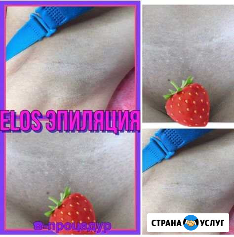 Элос Эпиляция, электроэпиляция Ялта - изображение 1