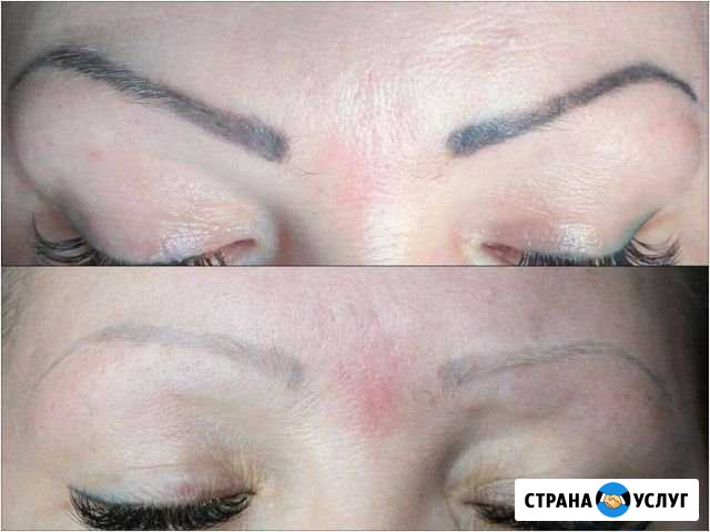 Удаление татуировок/татуажа лазером Кызыл - изображение 1
