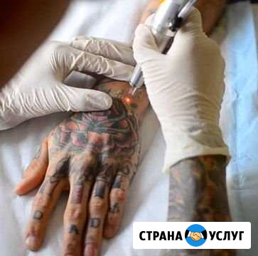 Удаление татуировок и татуажа бровей Тула - изображение 1