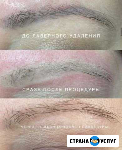 Профессиональное Лазерное Сведение Тату, Татуажа Петропавловск-Камчатский - изображение 1