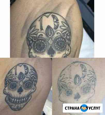 Удаление татуировки неодимовым лазером Санкт-Петербург