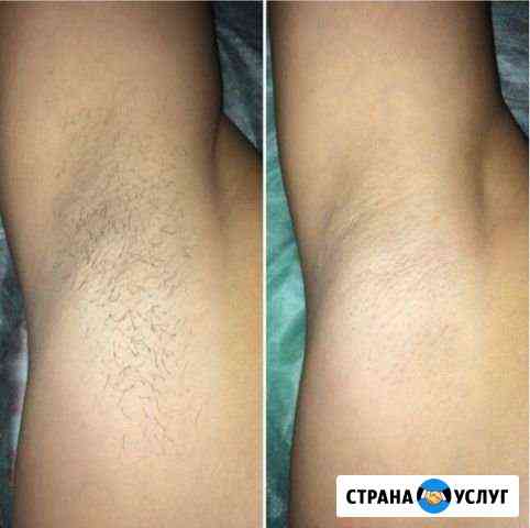 Шугаринг Энгельс