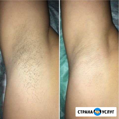 Шугаринг Энгельс - изображение 1