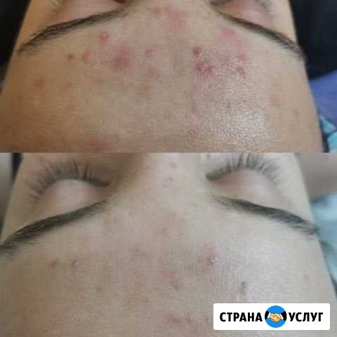 Ультразвуковая чистка лица Абакан - изображение 1