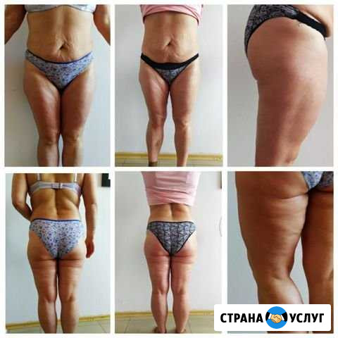 Массаж антицеллюлитный Новокузнецк - изображение 1