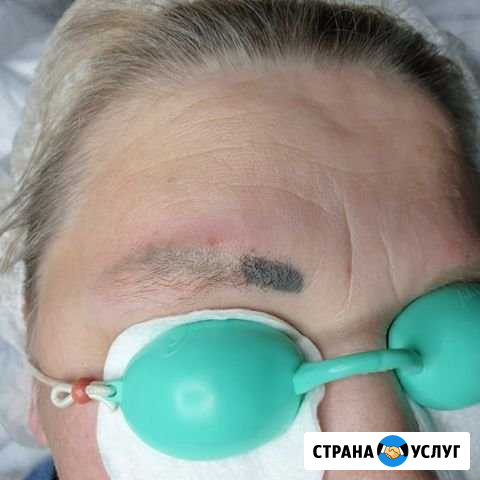 Удаление татуажа Ханты-Мансийск - изображение 1