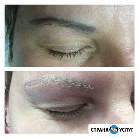 Удаление татуировок и татуажа лазером Улан-Удэ - изображение 1