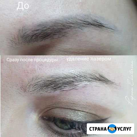Удаление татуажа, татуировки Хабаровск - изображение 1