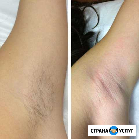 Эпиляция Волгоград - изображение 1