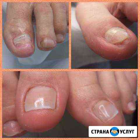 Аппаратный педикюр и подология Вологда